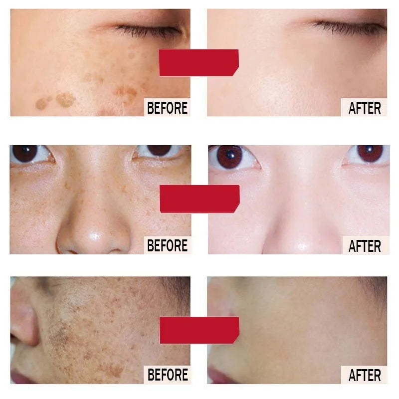 Freckle Whitening Cream Black Dots Melasma Remover Anti Brown Stain Lighten Pigmentation Moisturizing Skin Care Korean Products